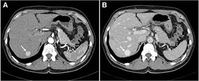 Primary Hepatic Leiomyoma in a Healthy Middle-Aged Woman: Literature Review and Case Report
